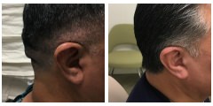 Cranioplasty Surgery Before & After Photos Beverly Hills