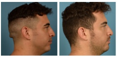 Crainoplasty2
