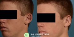 Ear Reduction Surgery