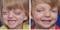 Monobloc with Internal Distraction Craniofacial Surgery Before & After Photos Beverly Hills