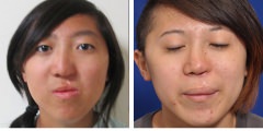 Orthognathic Surgery Corrective Jaw Surgery Before & After Photos Beverly Hills