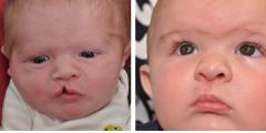 Cleft Lip & Cleft Palate Surgery Before & After Photos Beverly Hills