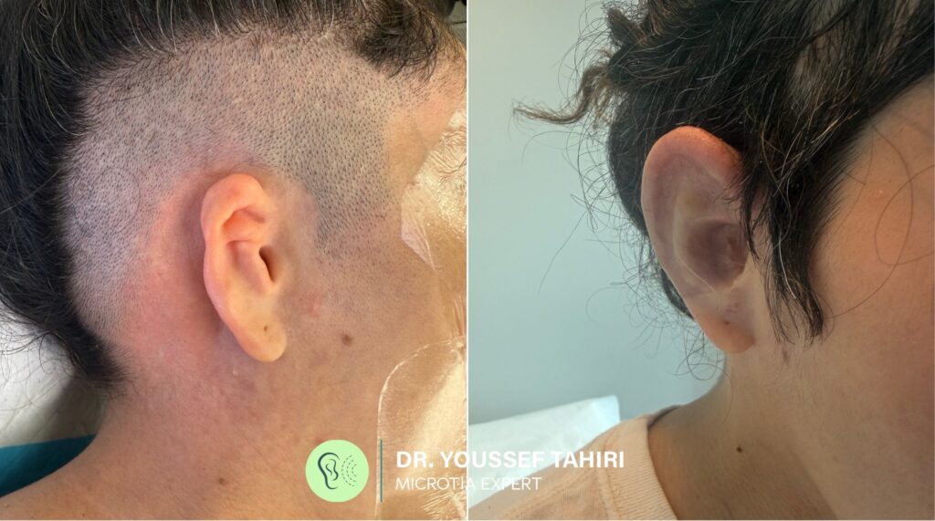 Before & After result