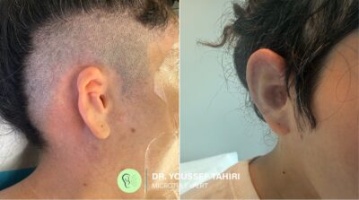 Before & After result