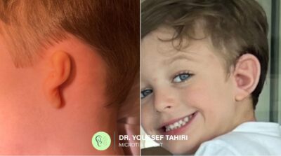 Before and after photos of microtia ear reconstruction by Dr. Youssef Tahiri — Case 01