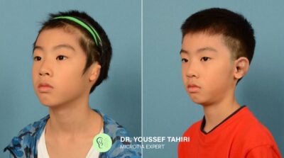 Before & After result