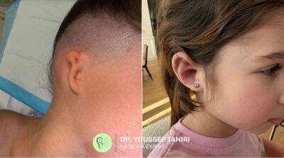 Before and after photos of microtia ear reconstruction by Dr. Youssef Tahiri — Case 02