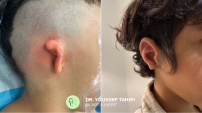 Before and after photos of microtia ear reconstruction by Dr. Youssef Tahiri — Case 03