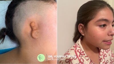 Before & After result