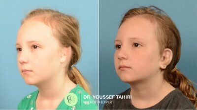 Before & After result