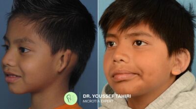Before & After result