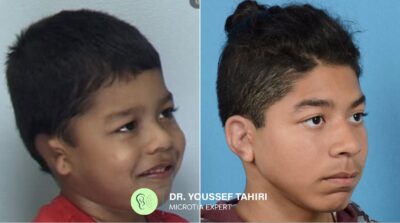 Before & After result