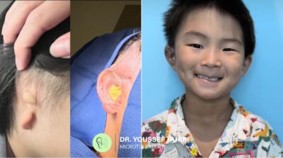 Before & After result