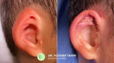 Before & After result