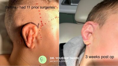 Before & After result