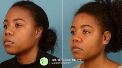 Before & After result