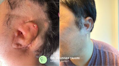 Before & After result
