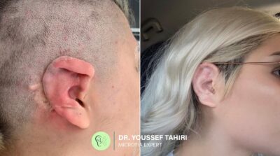 Before & After result