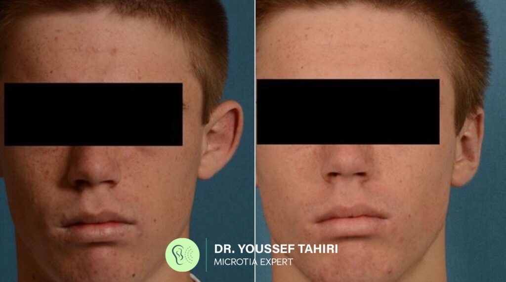 Before & After result