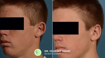 Before & After result