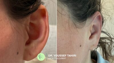 Before & After result