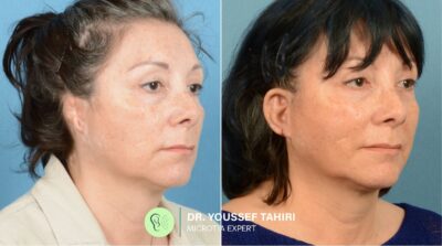 Before & After result