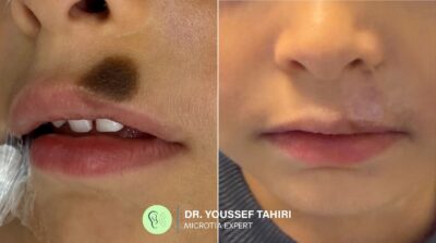 Before & After result