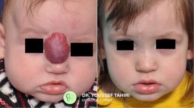 Before & After result