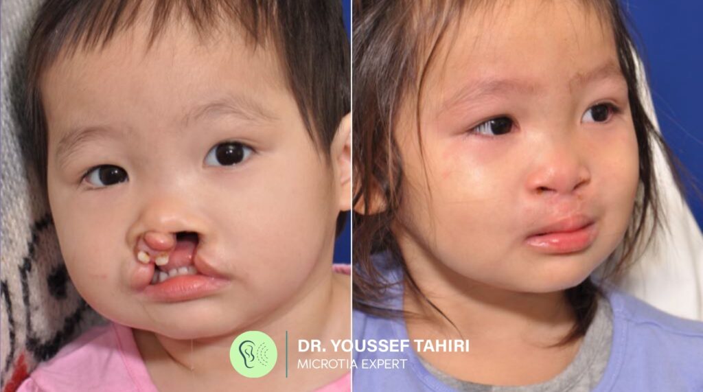 Before & After result