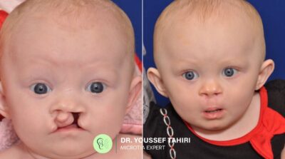 Before & After result