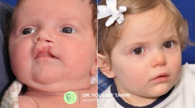 Before & After result