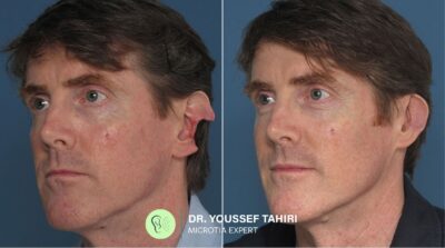 Before & After result