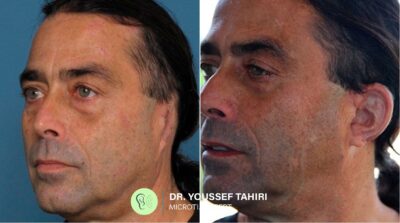Before & After result
