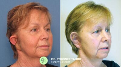 Before & After result