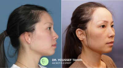 Before & After result