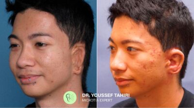 Before & After result