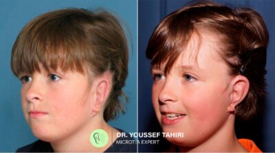 Before & After result