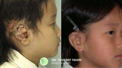 Before & After result