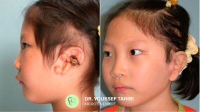 Before & After result