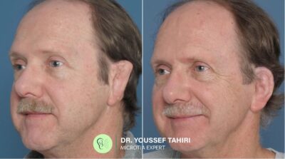 Before & After result