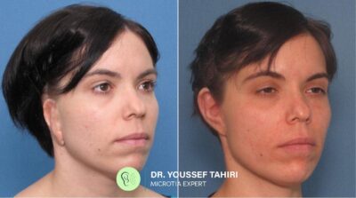 Before & After result