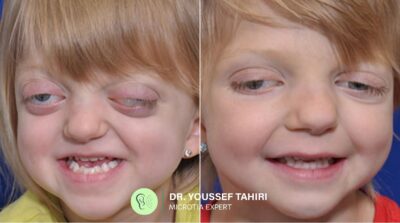 Before & After result