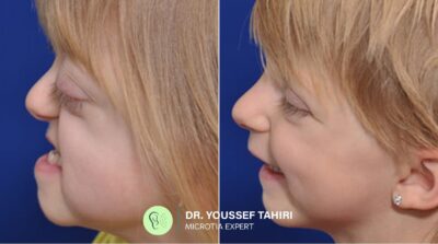 Before & After result