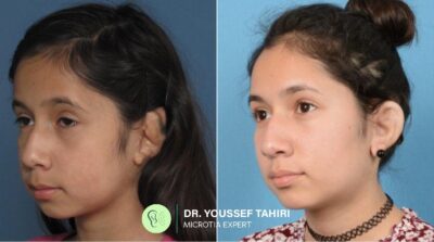 Before & After result