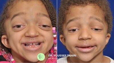 Before & After result