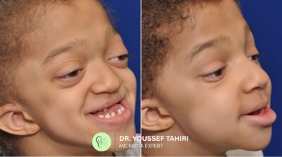 Before & After result