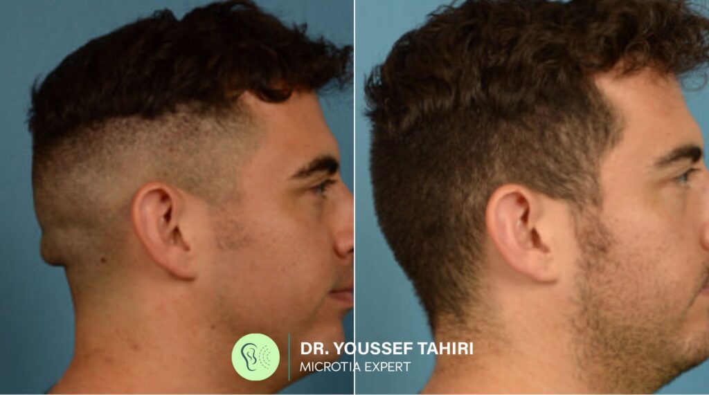 Before & After result