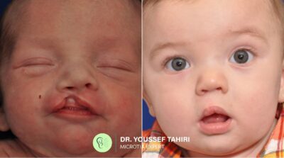 Before & After result