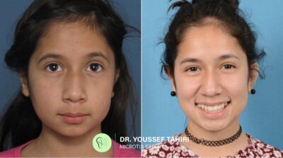 Before & After result
