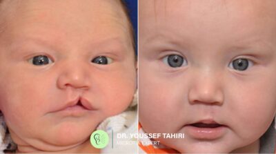Before & After result